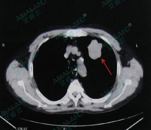 左上肺腺癌（CIK治疗+DC-CIK治疗）